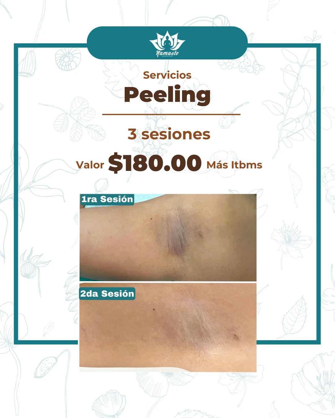 Peeling (3 Sesiones)