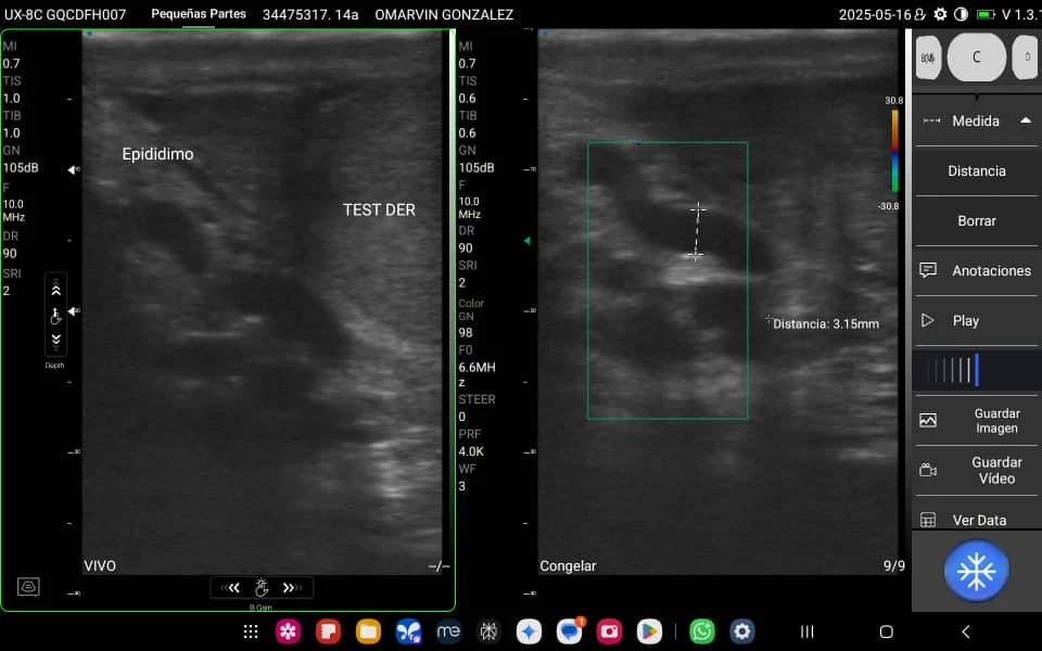 Ecografía Doppler testicular