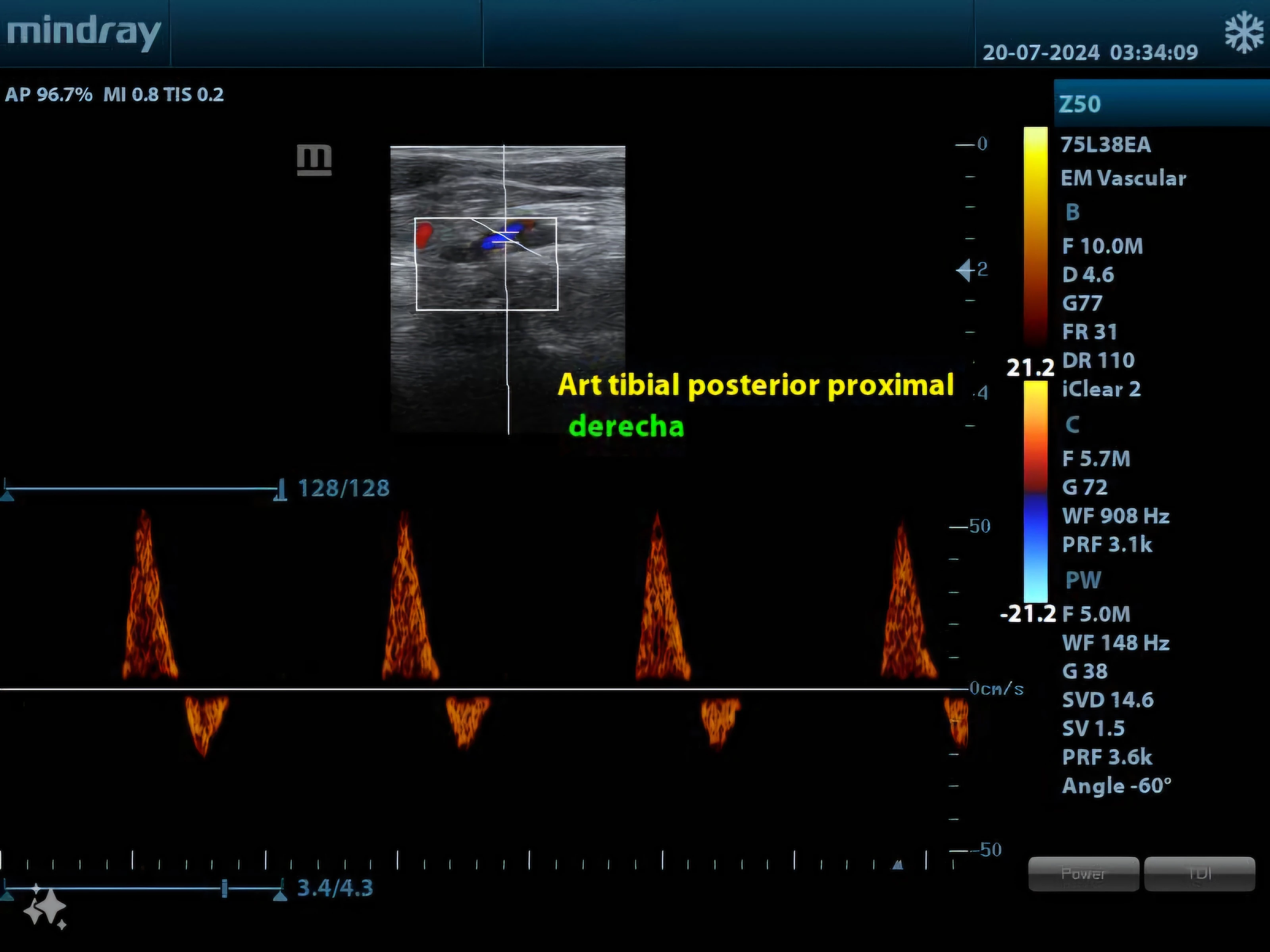 Ecografía Doppler arterial o venosa de miembros inferiores
