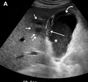 Ecografía abdominal
