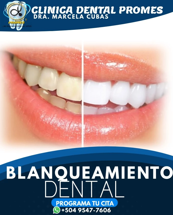 Blanqueamiento Dental
