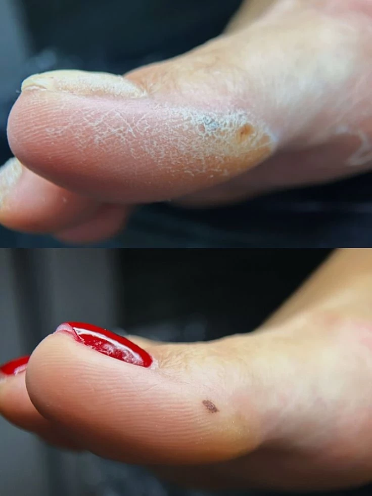 Pedicure curativo